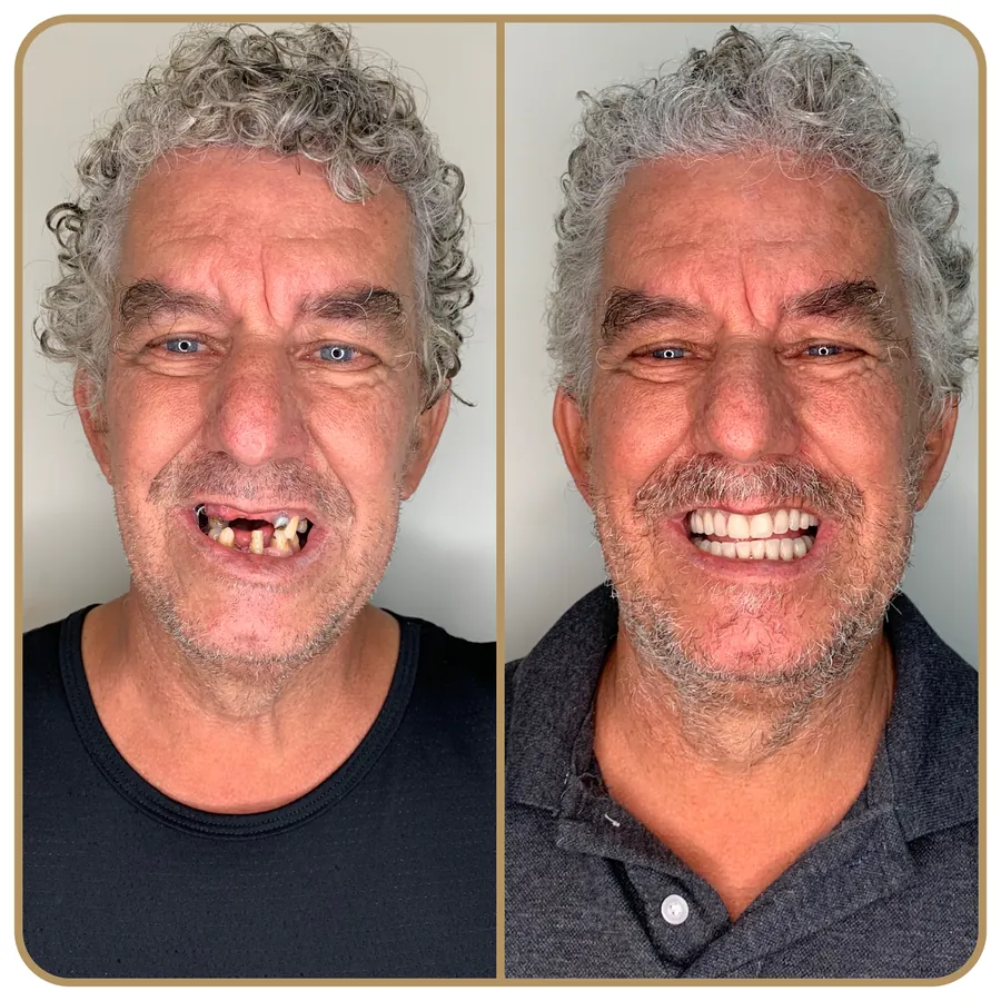 Antes e depois de reabilitação com implantes na Freire Odontologia