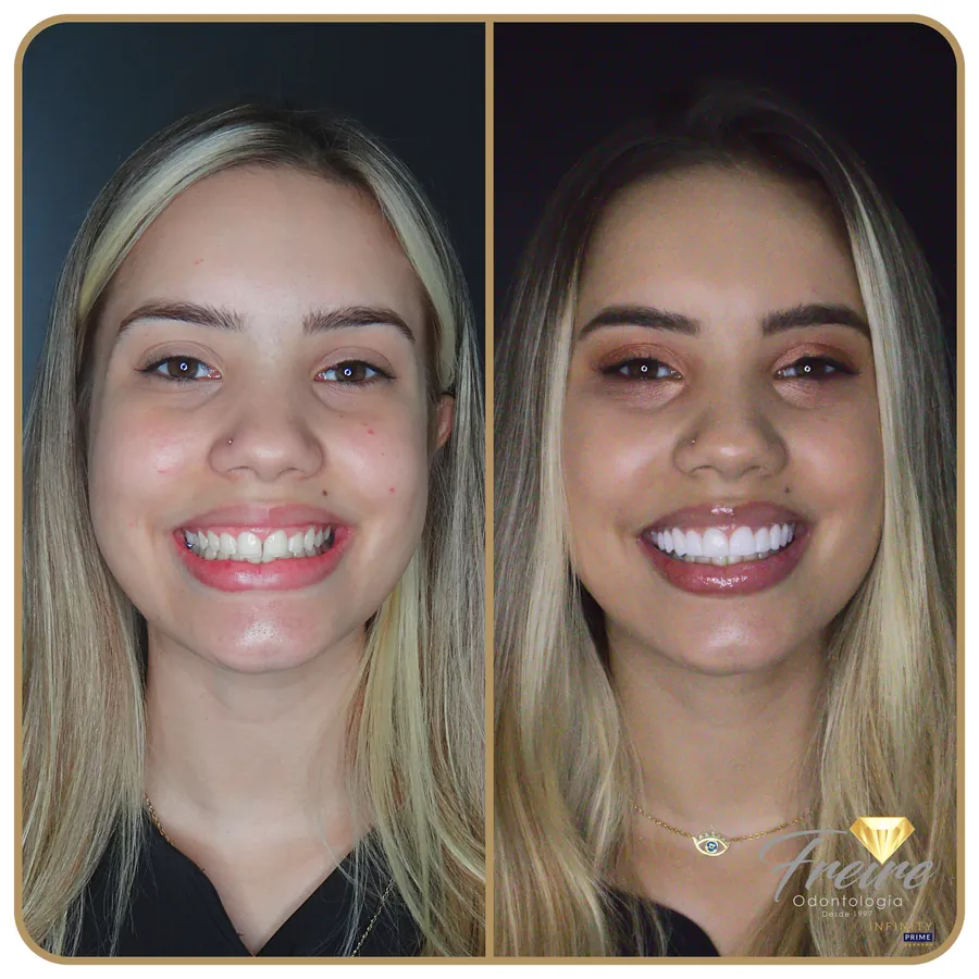 Antes e depois de facetas de porcelana na Freire Odontologia