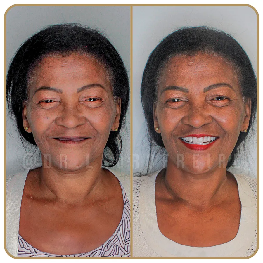 Antes e depois de prótese protocolo na Freire Odontologia