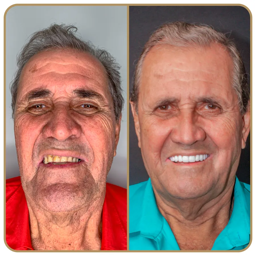 Antes e depois de reabilitação oral na Freire Odontologia