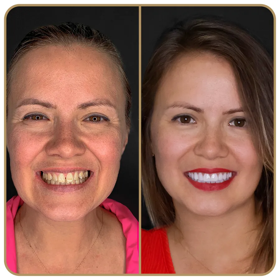 Antes e depois de tratamento estético na Freire Odontologia