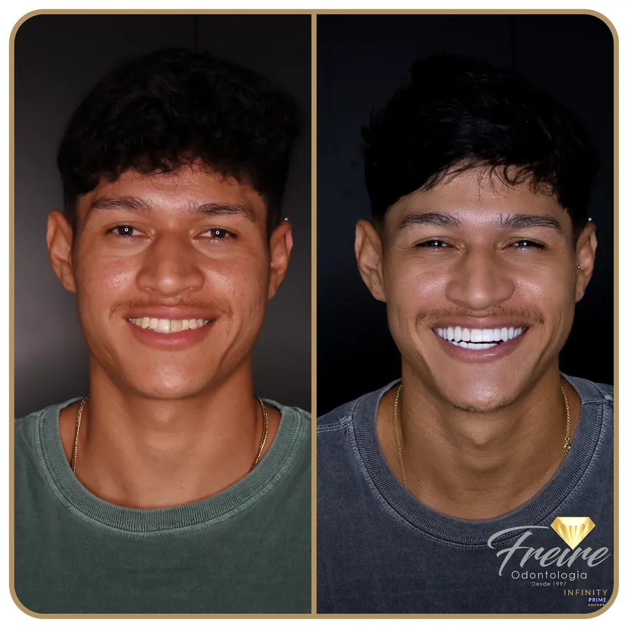 Antes e depois de tratamento do sorriso na Freire Odontologia