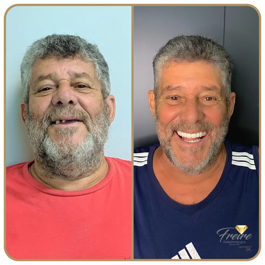 Antes e depois de dentes fixos na Freire Odontologia