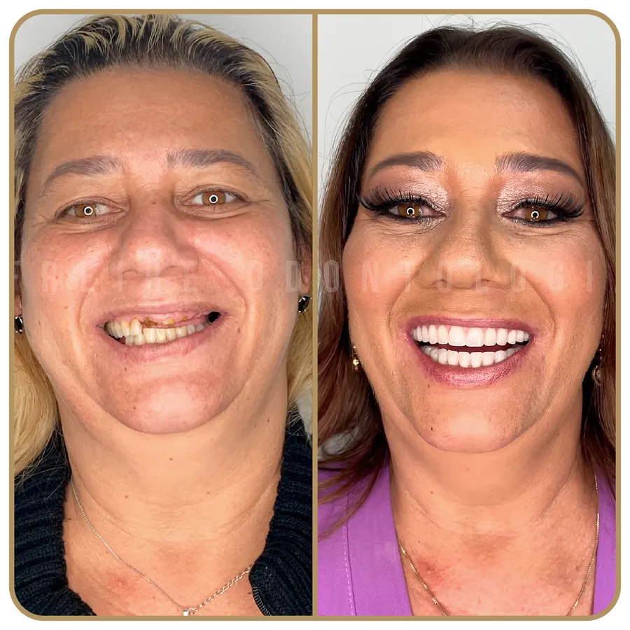 Antes e depois de reabilitação estética na Freire Odontologia