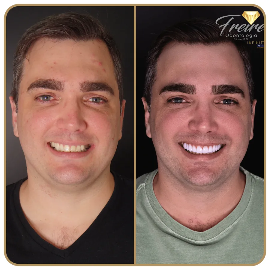 Antes e depois de facetas na Freire Odontologia